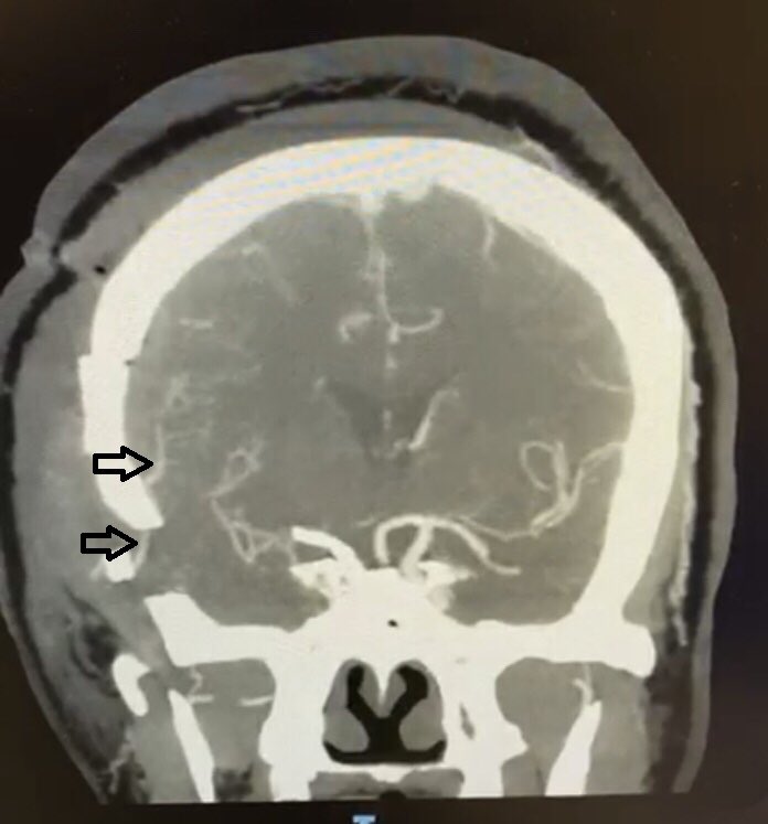 Mohsen Nouri (@mohsennourimd) on Twitter photo You would never forget your first ops...
Aug 5th, my first #brainsurgery as an attending, my first #Bypass , my first time using Exoscope, and my first surgery <a href="/lenoxhill/">Lenox Hill Hospital</a>. Thank you <a href="/drdavidlanger/">Dr. David Langer</a> for the great support and making this happen. <a href="/LenoxNeurosurg/">Lenox Hill Neurosurgery</a> <a href="/cvsection/">CV Section</a> You would never forget your first ops...
Aug 5th, my first #brainsurgery as an attending, my first #Bypass , my first time using Exoscope, and my first surgery <a href="/lenoxhill/">Lenox Hill Hospital</a>. Thank you <a href="/drdavidlanger/">Dr. David Langer</a> for the great support and making this happen. <a href="/LenoxNeurosurg/">Lenox Hill Neurosurgery</a> <a href="/cvsection/">CV Section</a>
