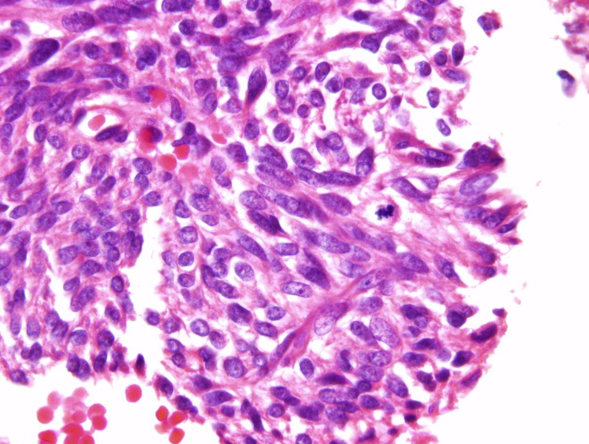 irem_onur_'s tweet photo. Monophasic synovial sarcoma consisting of typical #cells with short spindle nuclei and scant cytoplasm. 1) #FNA smear of the mass in the forearm, #DiffQuik 2) #Cellblock 3) IHC: TLE1 (+) #Cytopath #cytology #FNAFriday https://t.co/noh1N5WV0M