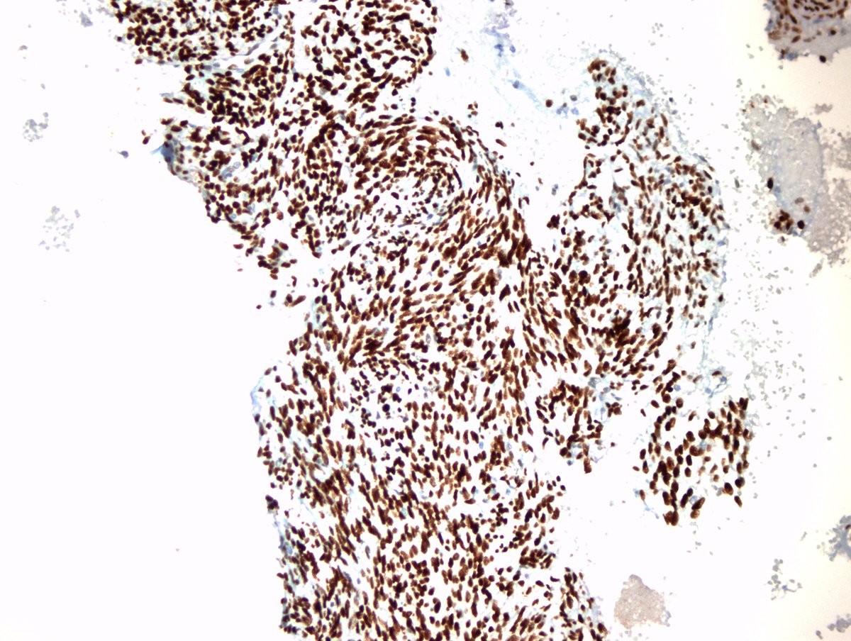 irem_onur_'s tweet photo. Monophasic synovial sarcoma consisting of typical #cells with short spindle nuclei and scant cytoplasm. 1) #FNA smear of the mass in the forearm, #DiffQuik 2) #Cellblock 3) IHC: TLE1 (+) #Cytopath #cytology #FNAFriday https://t.co/noh1N5WV0M