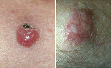 SunAWARE's tweet photo. Merkel Cell is increasing faster than melanoma. This detection acronym from the Skin Cancer Foundation is great: 
A: ASYMPTOMATIC lesion, not painful or tender
E: Lesion is EXPANDING rapidly
I: You are IMMUNOsuppressed
O: You are OLDER than 50
U: Lesion appears on UV-exposed skin https://t.co/qqoVA2kTTS