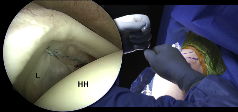 MillettMD's tweet photo. In this study, Dr. Millett and his colleagues highlight #rotatorcuff sparing arthroscopic #SLAPrepair with knotless all-suture anchors. This has significant benefits to throwing and overhead athletes. Read the full study here: https://t.co/iS9P0BGqik #medtwitter https://t.co/dL1LZMlkjs