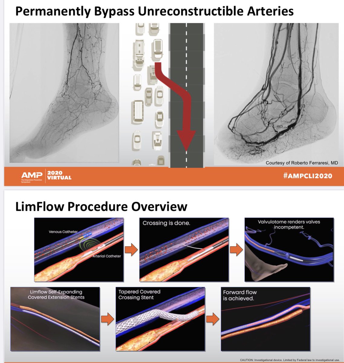 Amjad AlMahameed (@vascularman) on Twitter photo Packed late breaking data session at AMP20. New CLI strategies and devices being tested: SPUR Stent, MicroStent, Serration balloon, LimFlow (AVReversal). <a href="/AMPSymposium/">AMP the CLTI Meeting</a> <a href="/Mustapja/">Tegguer Mustapja</a> <a href="/CLI_Global/">CLI Global Society</a> <a href="/CLIGlobalNews/">CLI Global News</a> <a href="/GeorgeAdamsMD/">George Adams</a> <a href="/DrBobBeasley/">Robert Beasley</a> <a href="/bretwiechmann/">Bret Wiechmann</a> <a href="/monteromiguel/">ᗰIGᑌEᒪ ᗰOᑎTEᖇO-ᗷᗩKEᖇ</a> <a href="/NCVHonline/">New Cardiovascular Horizons</a> Packed late breaking data session at AMP20. New CLI strategies and devices being tested: SPUR Stent, MicroStent, Serration balloon, LimFlow (AVReversal). <a href="/AMPSymposium/">AMP the CLTI Meeting</a> <a href="/Mustapja/">Tegguer Mustapja</a> <a href="/CLI_Global/">CLI Global Society</a> <a href="/CLIGlobalNews/">CLI Global News</a> <a href="/GeorgeAdamsMD/">George Adams</a> <a href="/DrBobBeasley/">Robert Beasley</a> <a href="/bretwiechmann/">Bret Wiechmann</a> <a href="/monteromiguel/">ᗰIGᑌEᒪ ᗰOᑎTEᖇO-ᗷᗩKEᖇ</a> <a href="/NCVHonline/">New Cardiovascular Horizons</a>