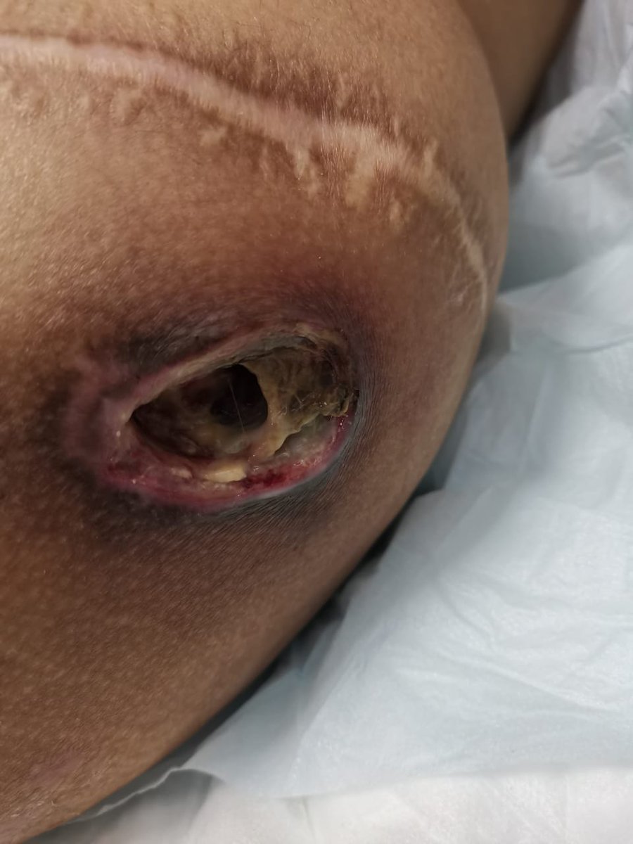 1h_sawadi's tweet photo. نداء #عاجل 
#وزارة_الصحة
#صحة_عسير  
@assirhealth 
@SaudiMOH
النظر في وضع حالة
المريض/ناصر سالم حديش نسأل الله له الشفاء العاجل
أرجوكم إلى متى هذه المعاناة؟!
للتواصل مع والده 
@saalemw1 
وضع المريض في خطر
@sabqorg
@okaz_brk
@AlArabiya_Brk 
@AlwatanSA 
@AlRiyadh https://t.co/kB5g5iHqXh