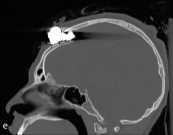 four patients retained bean bang components, four had intracranial hemorrhages. One patient presented with a depressed parietal skull fracture with associated subdural and subarachnoid hemorrhages, leading to a prolonged stay in the intensive care unit. (2/3)