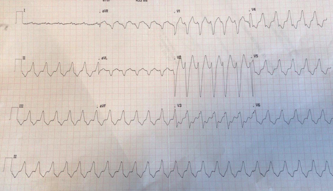 WCT LBBB morphology.
SVT or VT.
#Cardiologyfellows and #EPfellows first.
Pleas vote in the poll bellow.