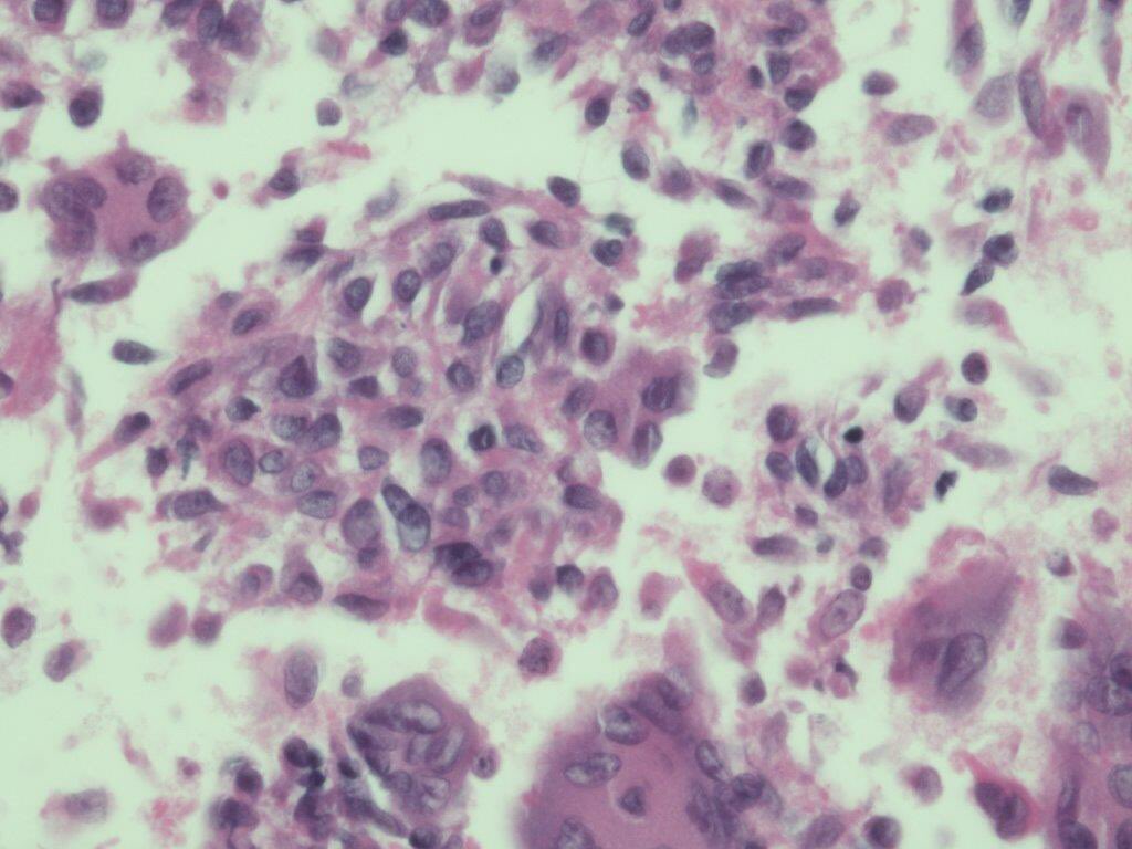 Giant cell tumor of the tendon sheath .The two components of tumor ie stromal cells and giant cells have similar nuclei . If hemosiderin laden macrophages are present ABC is in d/d #Cytopath #cytology #pathresidents #fnafriday #TemplePathology