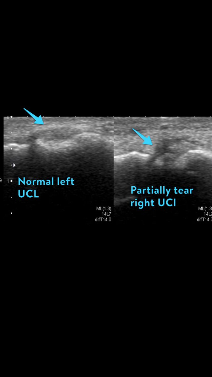 Baez1Adan's tweet photo. #FOAMrad #radres not always we have a Stenner lesion, sometimes is a Gamekeeper’s one! Blue arrow partially tear UCL, yellow arrow adductor pollicis tendon/aponeurosis. @MskSerme https://t.co/DxOpZbF90Z