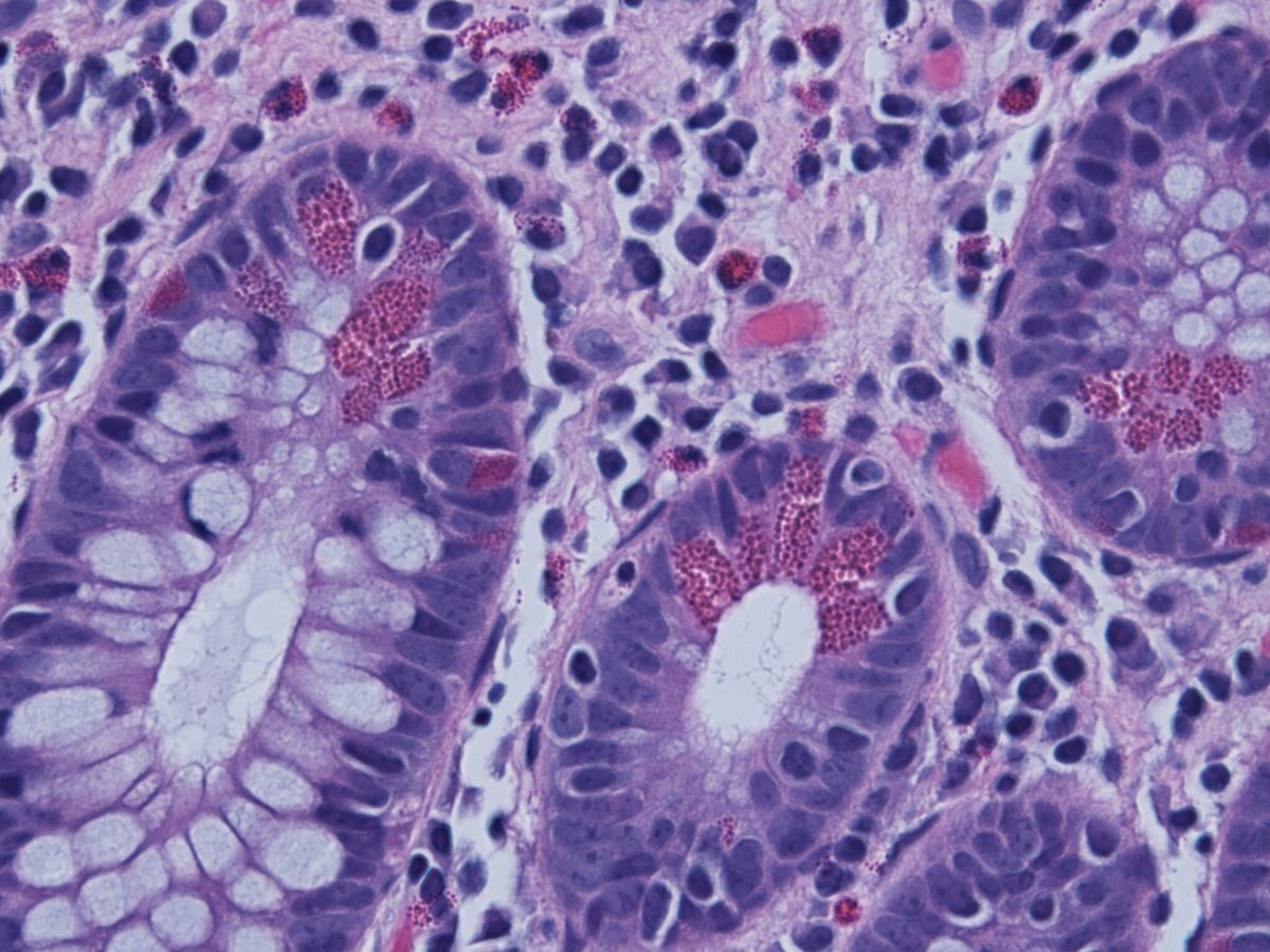 israhkhan's tweet photo. Paneth cells versus neuroendocrine cells of GIT. Right arrow paneth cells which have granules facing the lumen (right arrow)while neuroendocrine cells have granules facing the base (left arrow) #pathresidents #basicpathology https://t.co/Jn36G3dvqO