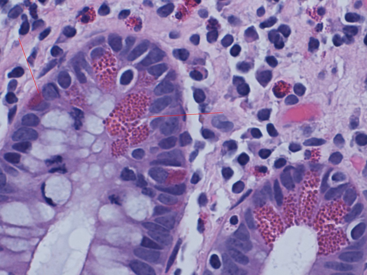 israhkhan's tweet photo. Paneth cells versus neuroendocrine cells of GIT. Right arrow paneth cells which have granules facing the lumen (right arrow)while neuroendocrine cells have granules facing the base (left arrow) #pathresidents #basicpathology https://t.co/Jn36G3dvqO