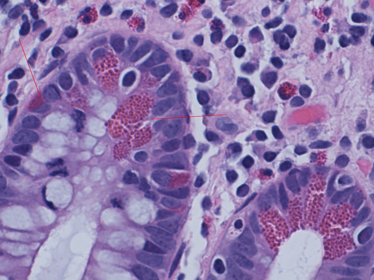 Paneth cells versus neuroendocrine cells of GIT. Right arrow paneth cells which have granules facing the lumen (right arrow)while neuroendocrine cells have granules facing the base (left arrow) #pathresidents #basicpathology