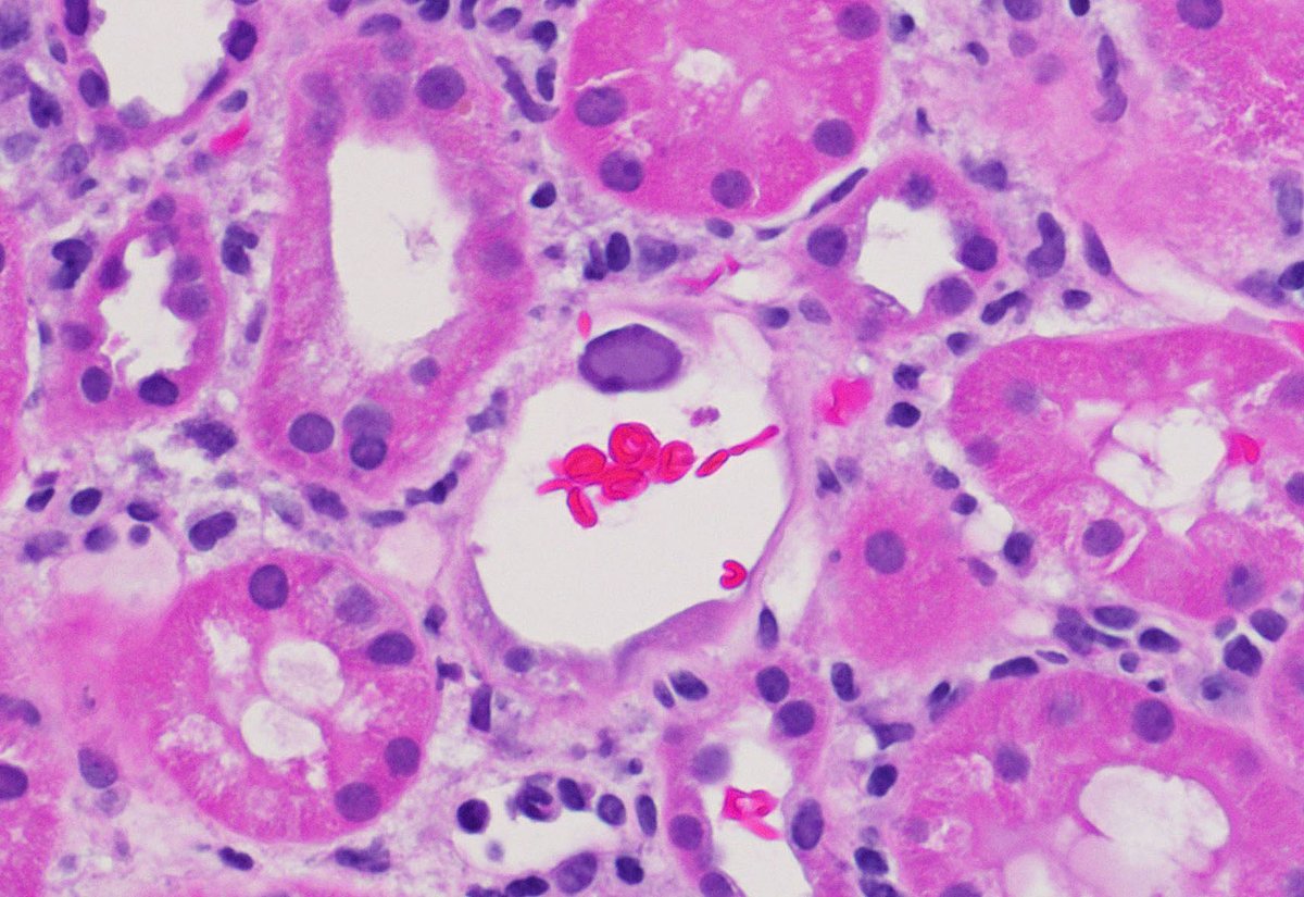 Finding this vessel in this active BK polyomavirus case made me (and our nephrologists) quite unhappy 🙄 @AZ_Neph #kidneypath