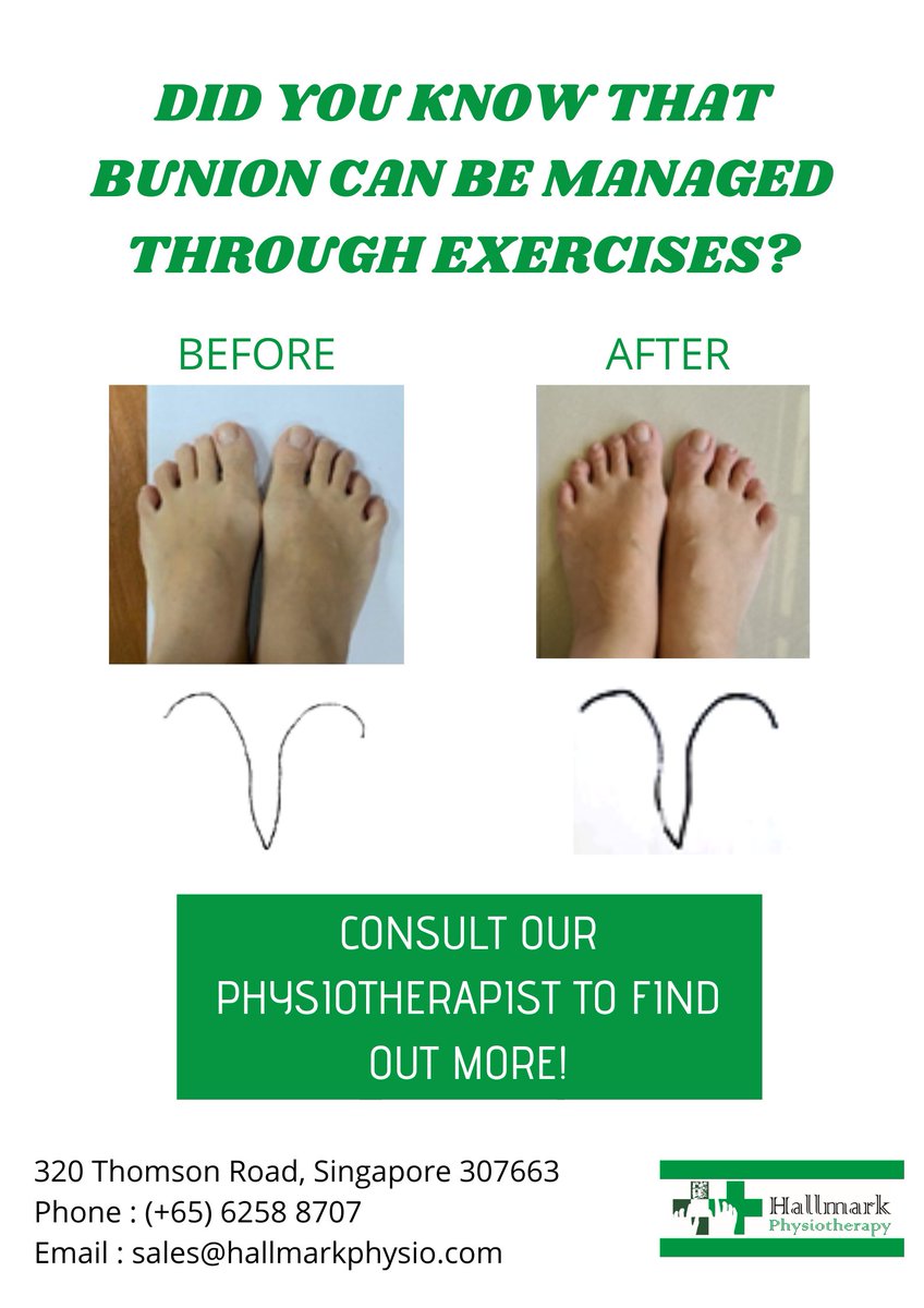 HallmarkPhysio's tweet image. Does your bunion cause you pain/discomfort? Contact us now to manage it by just doing simple exercises!