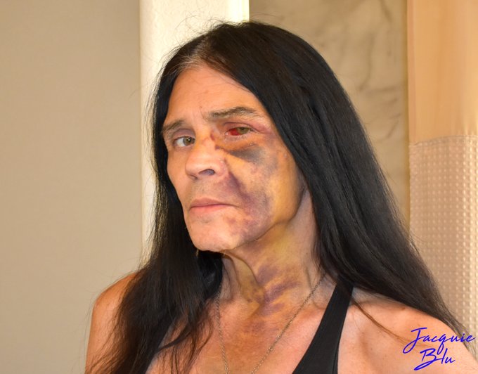 I swear, after all this heals I will never say that I don't like my face ever again! #JacquieBlu #BluDreamz<a href="/tag/jacquieblu"class="tags"><span>#jacquieblu</span></a><a href="/tag/bludreamz"class="tags"><span>#bludreamz</span></a>