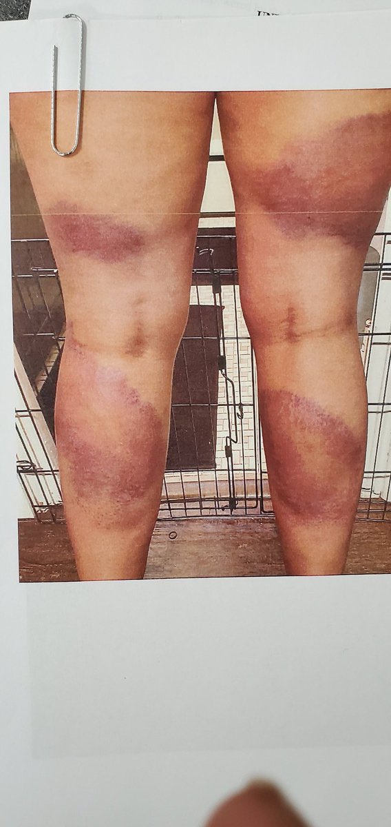 Kimmer4444's tweet photo. @AttorneyCrump This is what Ivore’s legs looked like after this beating. Her and Harding were walking back to their car 15 minutes after curfew began. It was still daylight. Instead of escorting them to their car, they were approached and handcuffed. https://t.co/dmksa37eOL