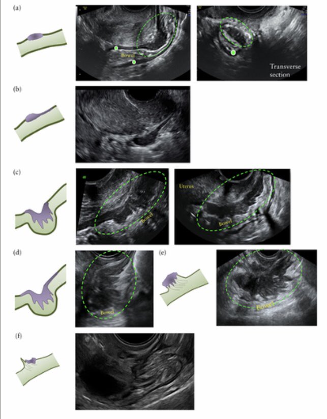 AliUltrasound's tweet photo. Q for the #sonologists & #surgeons.
Is IDEA nomenclature widely understood outside the US world? Eg. if we report a type e nodule as “pulling sleeve sign” is this something most clinicians would understand/ find clinically helpful?
@mathewleonardi @GeorgeCondous @Mikhail_MIGS https://t.co/yhnd0cmVIZ