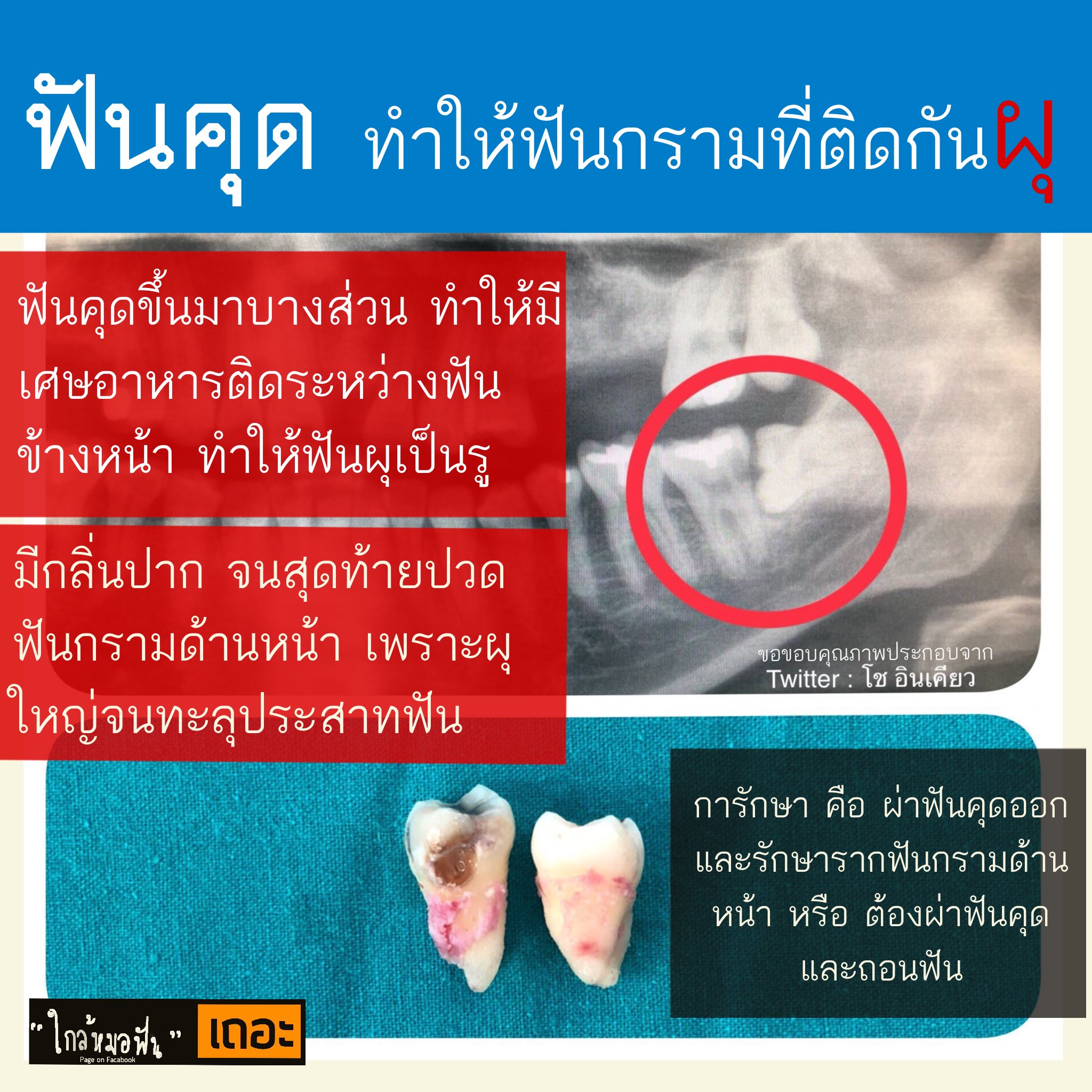 หมอฟัน ชื่อ นะ ™️ on Twitter: หมอฟัน ชื่อ นะ ™️ On Twitter: