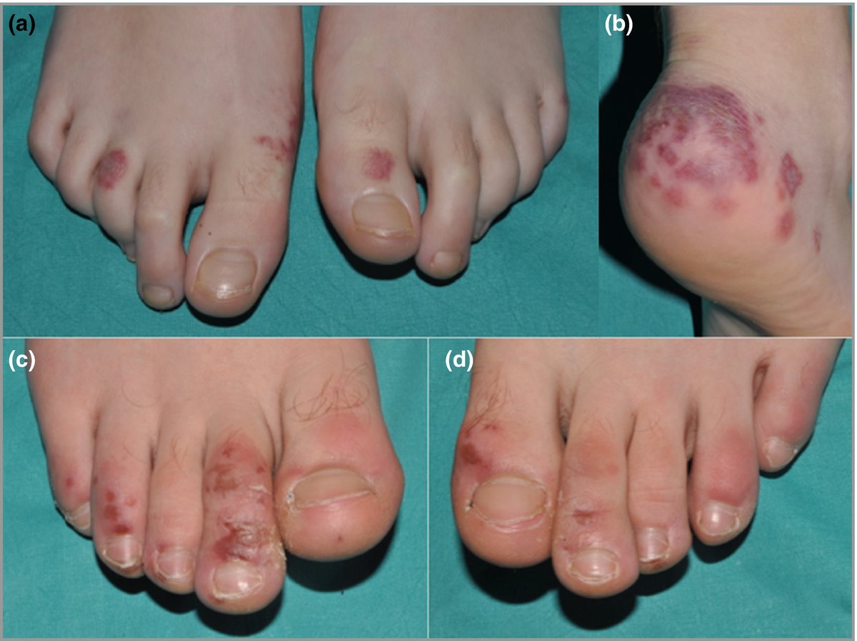 (1/12) The  #CovidToes mystery deepens again.It looks like they are caused by  #SARSCoV2 after all, but people have been looking with the wrong test.It seems pretty conclusive now that  #COVID19 cases in children are being missed.A short thread...