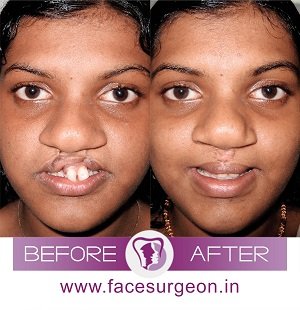 AndeiSoI's tweet photo. #cleftrepair #cleftcutie #drsunilrichardson #maxfax #facesurgeon #facesurgery https://t.co/37apuEB9Lr