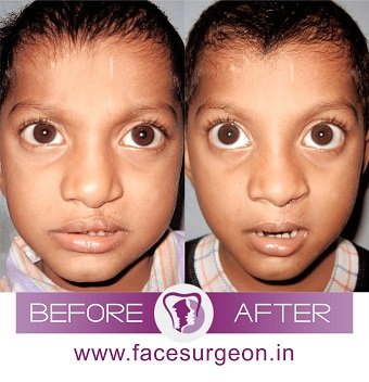 AndeiSoI's tweet photo. Happiness is seeing amazing results in the patients with desired results .#cleftrepair #cleftsurgery #liprevision https://t.co/b1acLHe7wv