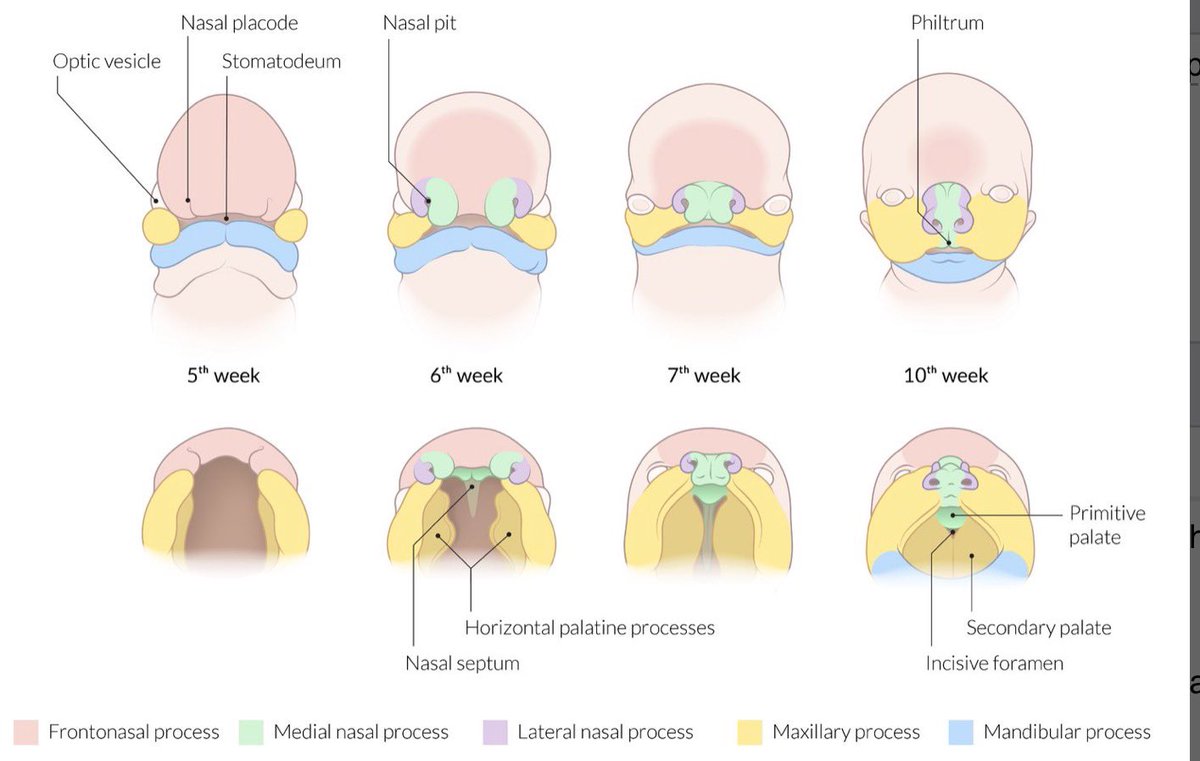 Cleft lip occurs when maxillary prominence fails to fuse with midline nasal prominence.Cleft palate occurs when palatine prominences fail to fuse.The majority of cases occur in isolation, and are not associated with a syndrome.