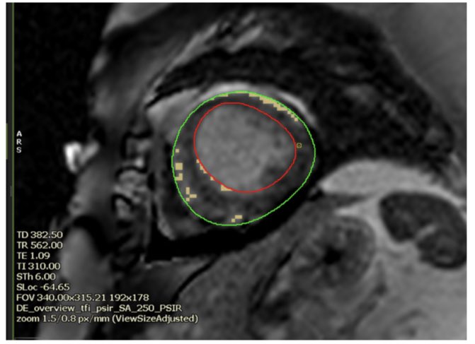  #whyCMR LGE at +3SD threshold, none at +5 SD threshold  @circlecvi  @drkartikganga  @avinash230791  @Ahmed43101178 , raised T1 and T2 mapping values