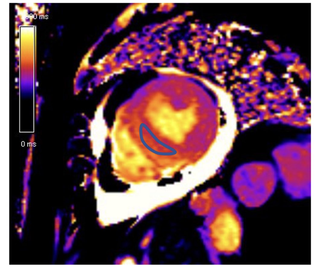  #whyCMR LGE at +3SD threshold, none at +5 SD threshold  @circlecvi  @drkartikganga  @avinash230791  @Ahmed43101178 , raised T1 and T2 mapping values