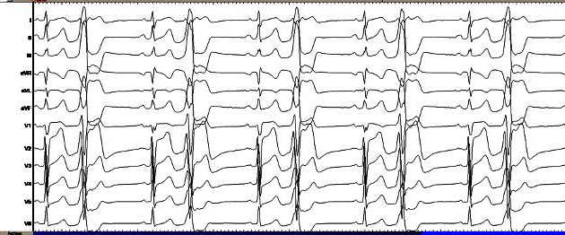 PVC from R-L Cusp junction #EPeeps
