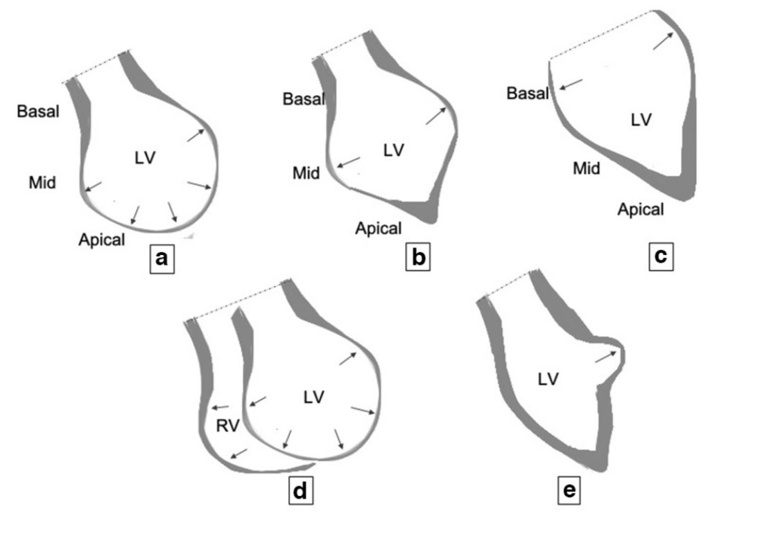 Role of  #whyCMR in Takotsubo CM (TC): reversible transient LV dysfunction most commonly basal hyperkinesis and mid-apicalLV ballooning and hypokinesia (a) other phenotypes may be present (b-d)  diffuse edema/raised T2  https://www.birpublications.org/doi/abs/10.1259/bjr.20200514