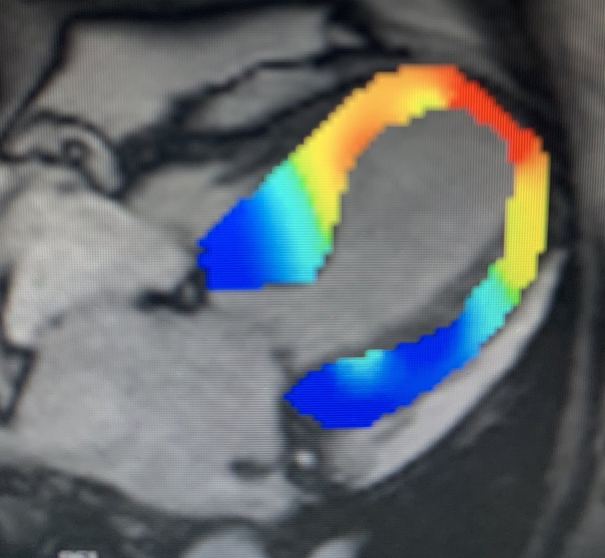  #whyCMR in TC:absence of LGE (at +5SD threshold) , but recent studies suggest LGE may be present T1 and ECV mapping detect diffuse ECM abnormalities- here ECV normal at basal LV, increased at apical LVstrain can help detect myocardial deformation abnormalities