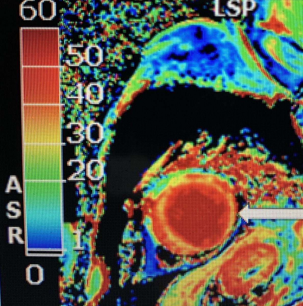  #whyCMR in TC:absence of LGE (at +5SD threshold) , but recent studies suggest LGE may be present T1 and ECV mapping detect diffuse ECM abnormalities- here ECV normal at basal LV, increased at apical LVstrain can help detect myocardial deformation abnormalities