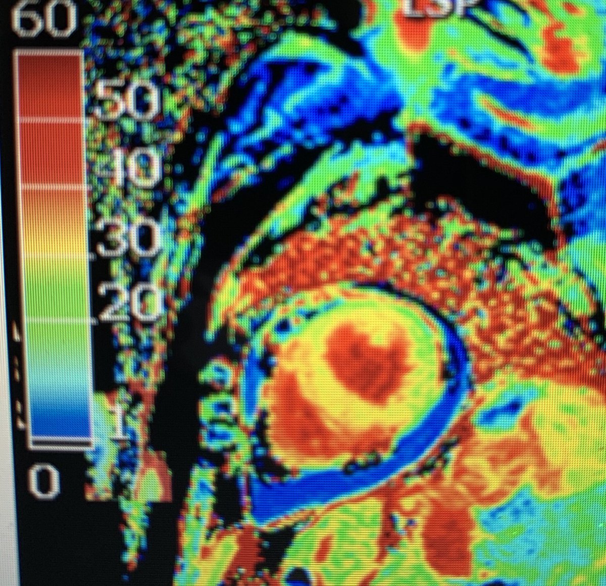  #whyCMR in TC:absence of LGE (at +5SD threshold) , but recent studies suggest LGE may be present T1 and ECV mapping detect diffuse ECM abnormalities- here ECV normal at basal LV, increased at apical LVstrain can help detect myocardial deformation abnormalities