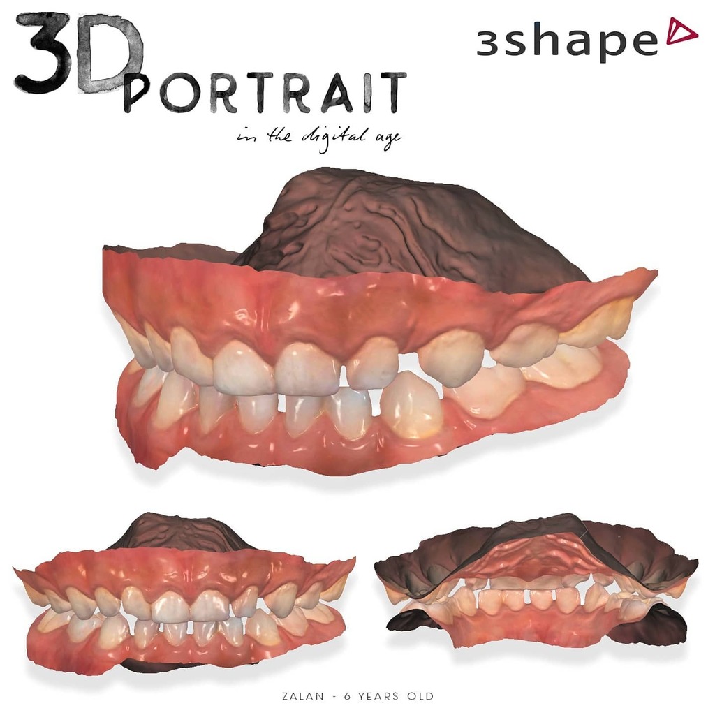 LorantStumpf's tweet photo. Thanks to the support of the local dealer of #3shapetrios 🙏🏻👍🏻 I was able to test a #trios4 wireless scanner. It was fun to scan my 6 years son without any problem ❤️🎉👏🏻🔝 AMAZING EXPERIENCE as always. Let's make 3D oral portraits from our beloved one… https://t.co/YasPyF6rpS https://t.co/YepLJNXxs5