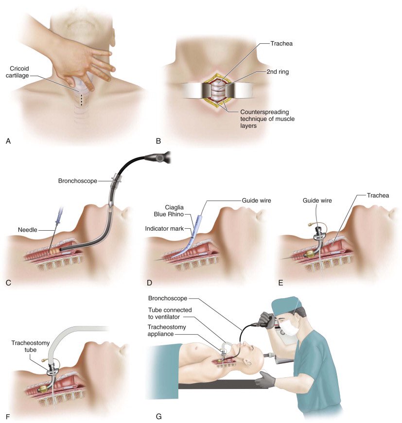 percutaneous tracheostomy procedure