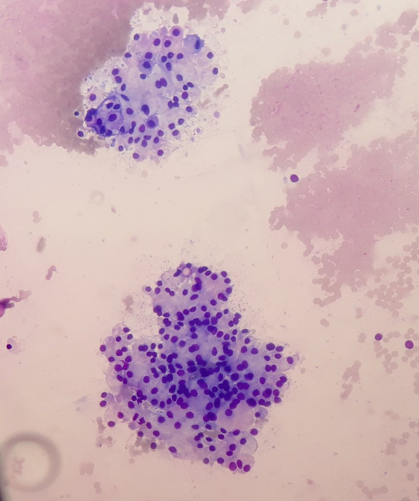 PomaEloiza's tweet photo. Fine needle aspiration cytology of supraclavicular lymph node.
70-year-old-female with history of cancer of the parotid gland in 2006.
#cytopathology #FNA #Papstain #panopticstain #pathology #cytopath https://t.co/aoiiYEVl3i