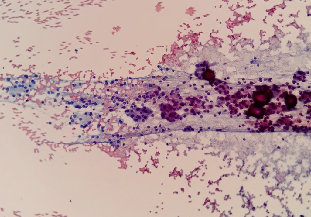 PomaEloiza's tweet photo. Fine needle aspiration cytology of supraclavicular lymph node.
70-year-old-female with history of cancer of the parotid gland in 2006.
#cytopathology #FNA #Papstain #panopticstain #pathology #cytopath https://t.co/aoiiYEVl3i