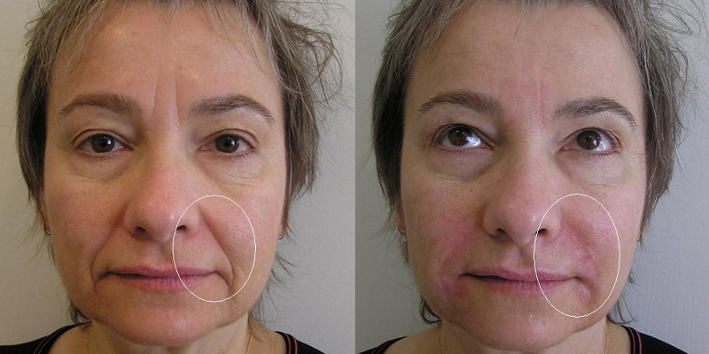 InfinitySkinLA's tweet photo. WOW! What a difference fillers have done for this patient!  #wrinkles #byewrinkles https://t.co/obuUDDdGZb