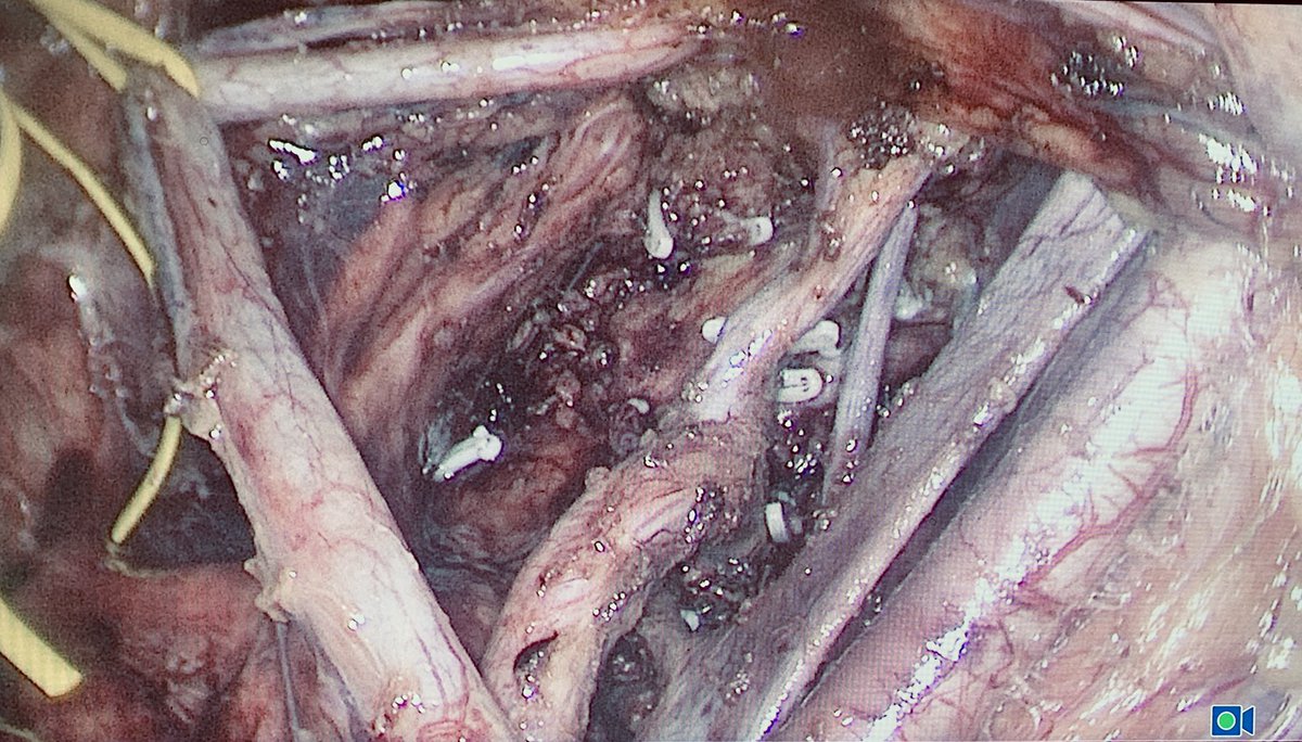 Technical #challenge case in #colorectal surgery at <a href="/CirugiaGralHIBA/">Cirugía General Hospital Italiano de Buenos Aires</a>. Laparoscopic #TME and Lateral node dissection for distal #rectalcancer after neoadjuvant chemoradiation, performed with <a href="/JuanCampana_MD/">Juan Pablo Campana</a> and <a href="/MentzRicardo/">Ricardo Mentz</a>. Example of #teamwork and multidisciplinary management!