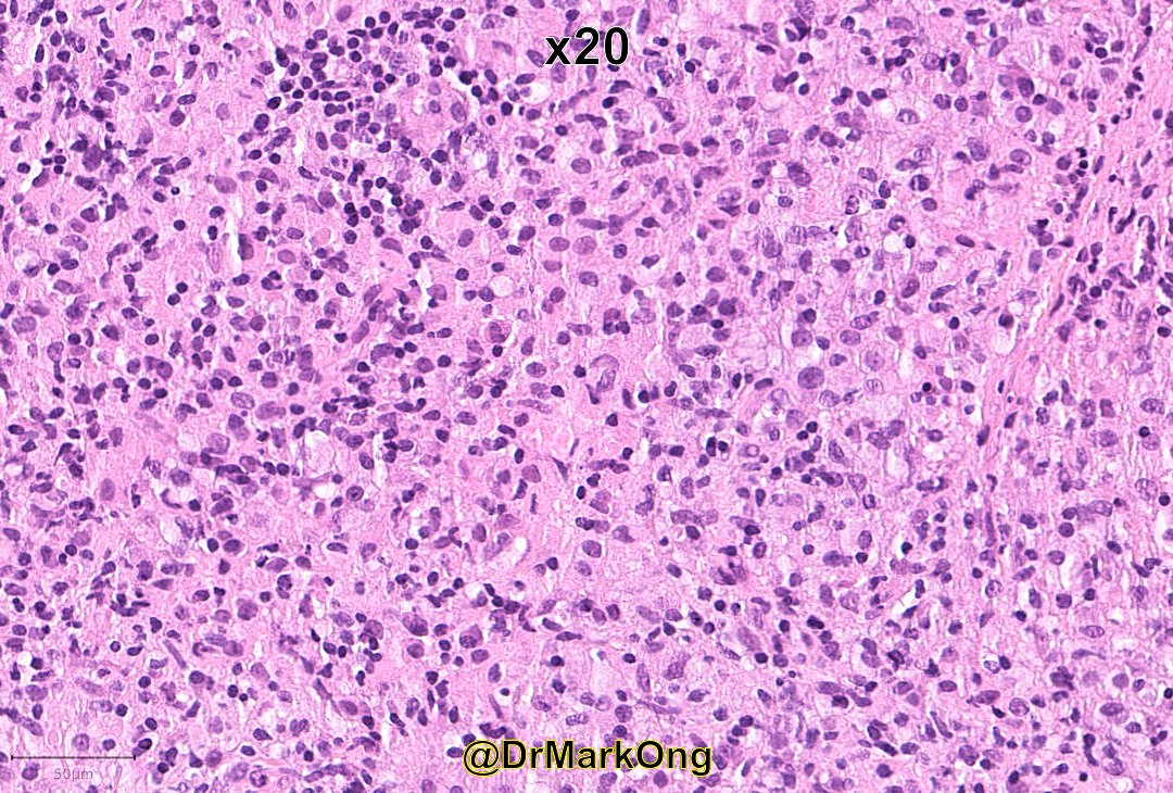 DrMarkOng's tweet photo. 40M lymphadenopathy and B-symptoms.

I really wished I'd taken pictures of IHC at the time (no easy access to camera then), so you will have to trust me on the final diagnosis.

Any takers with just a H&amp;E? #hemepath https://t.co/6O6OplkkJ2