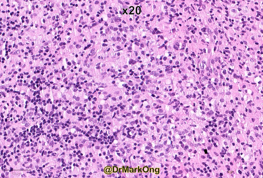 DrMarkOng's tweet photo. 40M lymphadenopathy and B-symptoms.

I really wished I'd taken pictures of IHC at the time (no easy access to camera then), so you will have to trust me on the final diagnosis.

Any takers with just a H&amp;E? #hemepath https://t.co/6O6OplkkJ2