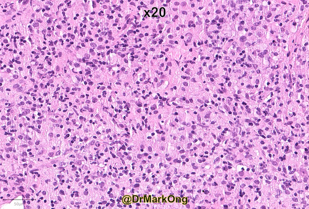 DrMarkOng's tweet photo. 40M lymphadenopathy and B-symptoms.

I really wished I'd taken pictures of IHC at the time (no easy access to camera then), so you will have to trust me on the final diagnosis.

Any takers with just a H&amp;E? #hemepath https://t.co/6O6OplkkJ2