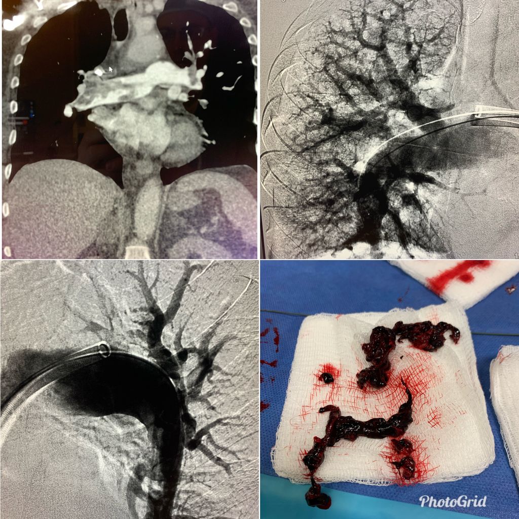 AustinBourgeois's tweet image. Middle aged patient, COVID + with submassive PE.  RV strain, elevated troponin, hypoxia.  Treated with T20 flowtriever. 11 passes.  PA systolic pressure 67-&amp;gt; 38mmHg.  #iRad