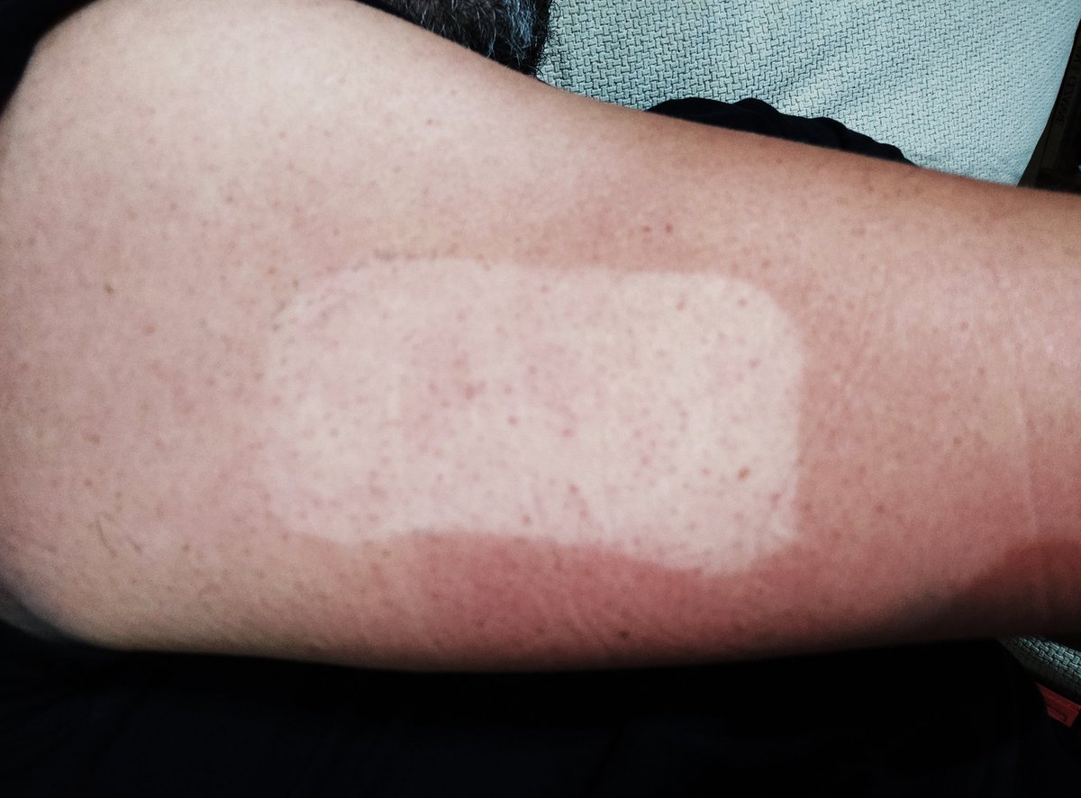 bertfernand's tweet photo. A nice #dexcomg5 tattoo for this summer 
#wearenotwaiting #DIY #artificialpancreas #androidaps https://t.co/8G6w35cYIK