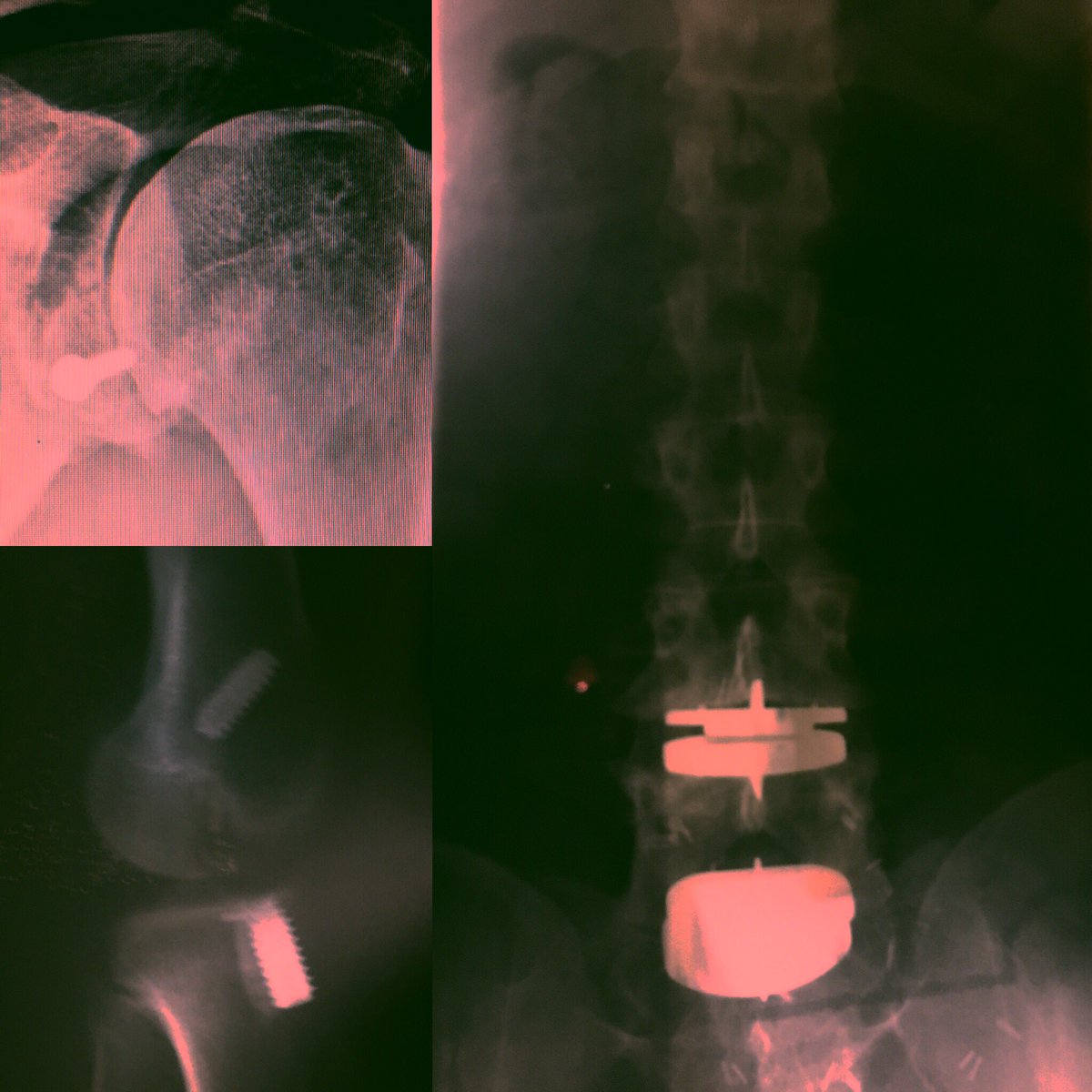 KnouPeace's tweet photo. @EdithC28 LOVE to go back to my old self physically...to WORK, an ex-athlete, and many injuries I cannot even count. So society- SHIT my best friend thinks I should “come on do something”.I “look” normal.  Maybe I could let people wear X-ray glasses to see my hardware and scar tissue? #wtf https://t.co/1B6zORvsa2