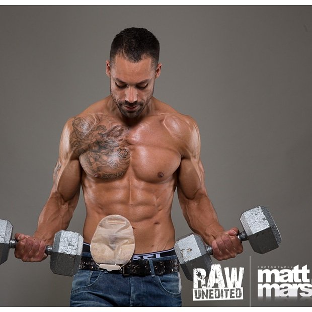 My first photo shoot after surgery, I'd never taken my top off and showed anyone my "bag" literally felt sick on my journey to Matts studio but sharing that first picture changed me as a person it lifted this huge weight off my shoulders and helped me accept the new me. #stoma