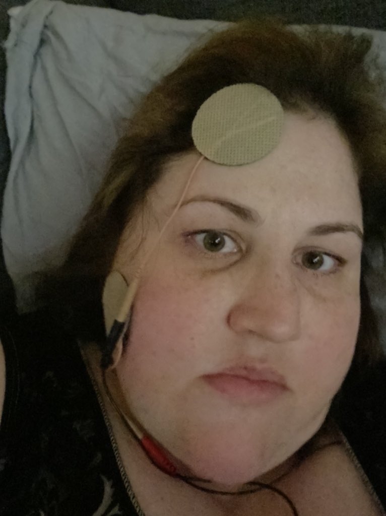 Medical_Oddity's tweet photo. Things we do to try to stop the pain. A novel in many parts. The tens unit only takes my mind off of the pain, it doesnโt get rid of it. #tmj #trigeminalneuralgia #chronicmigraine #chroniclife #didNotWork https://t.co/phpCJGrLeX