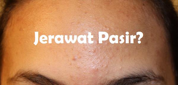 jerawat pasir in english