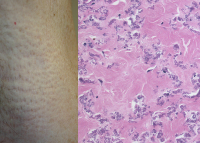 What's your #diagnosis? Short #dermpath video with answer at youtu.be/oVECFgiNkLk #cpKo #dermatologia #pathtwitter