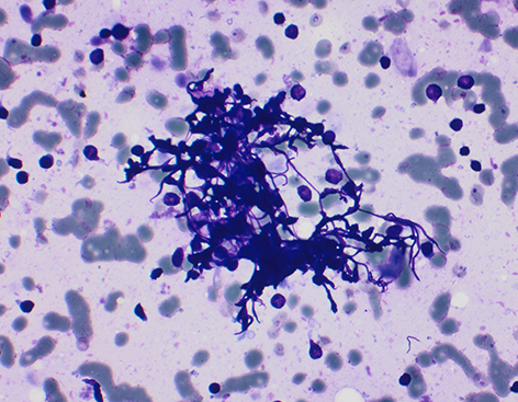 gildasantoscyto's tweet photo. T is for tangles "lymphoid tangles"=clusters/aggregates of crushed #lymphocyte nuclei as frequently seen in lymphoid lesions but a useful feature for #lymphocytic thyroiditis and #Warthin tumour as in this case 👇#CytoABCs #pathology trainees #cytopath #citologia #PAAF #FNA https://t.co/QfyffFmVmQ