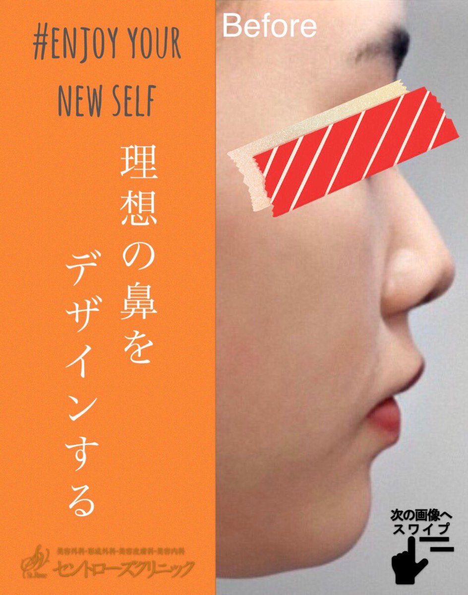 セントローズクリニック 美容外科 美容皮膚科 理想のノーズラインをセントローズで 高い鼻で欧米人のような印象に 小顔にも見えちゃうかも 鼻 高い鼻 低い鼻 団子鼻 鷲鼻 コンプレックス コンプレックス解消 欧米人 アジア 仙台 セントローズクリニック 美容外科 美容皮膚科 理想のノーズラインをセントローズで 高い鼻で欧米人のような印象に 小顔にも見えちゃうかも 鼻 高い鼻 低い鼻 団子鼻 鷲鼻 コンプレックス コンプレックス解消 欧米人 アジア 仙台