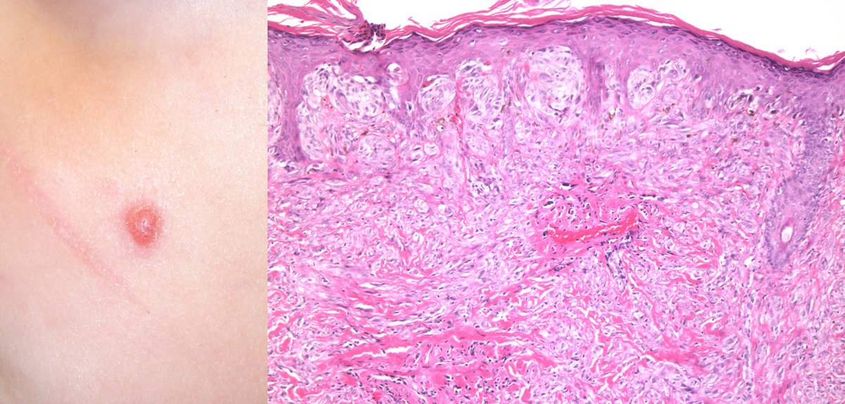 ChristineJKoMD's tweet photo. What's your #dermpath #diagnosis? Short #clinpathcorrelation answer at https://t.co/wGm294yzoJ #cpKo #PathTwitter https://t.co/wiUcmH87Xo